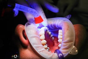 Изберете зъбни импланти 9